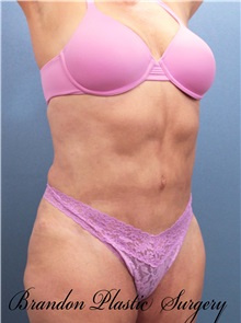 Tummy Tuck After Photo by Marvin Shienbaum, MD; Brandon, FL - Case 30478