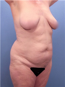 Tummy Tuck Before Photo by Marvin Shienbaum, MD; Brandon, FL - Case 30478