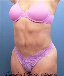 Tummy Tuck After Photo by Marvin Shienbaum, MD; Brandon, FL - Case 30478