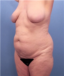 Tummy Tuck Before Photo by Marvin Shienbaum, MD; Brandon, FL - Case 30478