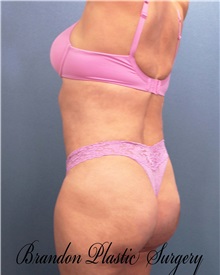 Tummy Tuck After Photo by Marvin Shienbaum, MD; Brandon, FL - Case 30478