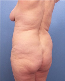 Tummy Tuck Before Photo by Marvin Shienbaum, MD; Brandon, FL - Case 30478