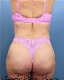 Tummy Tuck After Photo by Marvin Shienbaum, MD; Brandon, FL - Case 30478