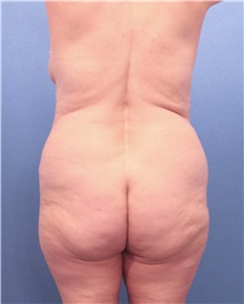 Tummy Tuck Before Photo by Marvin Shienbaum, MD; Brandon, FL - Case 30478