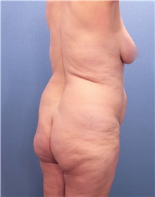 Tummy Tuck Before Photo by Marvin Shienbaum, MD; Brandon, FL - Case 30478