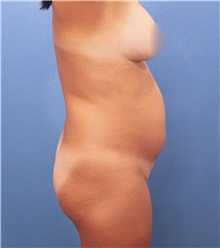 Tummy Tuck Before Photo by Marvin Shienbaum, MD; Brandon, FL - Case 30481