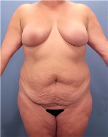 Tummy Tuck Before Photo by Marvin Shienbaum, MD; Brandon, FL - Case 30482