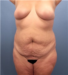 Tummy Tuck Before Photo by Marvin Shienbaum, MD; Brandon, FL - Case 30482