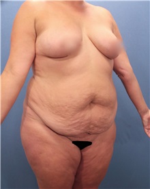 Tummy Tuck Before Photo by Marvin Shienbaum, MD; Brandon, FL - Case 30482