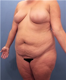 Tummy Tuck Before Photo by Marvin Shienbaum, MD; Brandon, FL - Case 30482