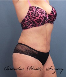 Tummy Tuck After Photo by Marvin Shienbaum, MD; Brandon, FL - Case 30482