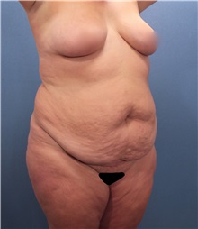 Tummy Tuck Before Photo by Marvin Shienbaum, MD; Brandon, FL - Case 30482