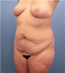 Tummy Tuck Before Photo by Marvin Shienbaum, MD; Brandon, FL - Case 30482