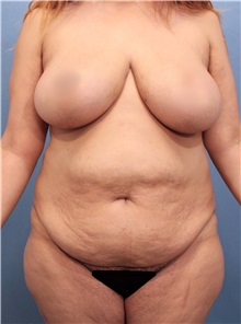 Tummy Tuck Before Photo by Marvin Shienbaum, MD; Brandon, FL - Case 30486