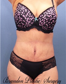 Tummy Tuck After Photo by Marvin Shienbaum, MD; Brandon, FL - Case 30486