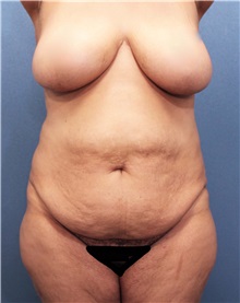 Tummy Tuck Before Photo by Marvin Shienbaum, MD; Brandon, FL - Case 30486