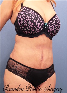 Tummy Tuck After Photo by Marvin Shienbaum, MD; Brandon, FL - Case 30486