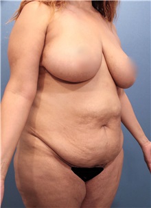 Tummy Tuck Before Photo by Marvin Shienbaum, MD; Brandon, FL - Case 30486