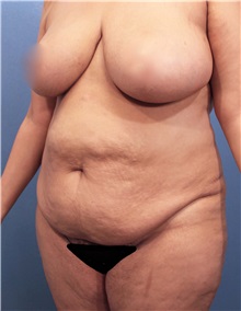 Tummy Tuck Before Photo by Marvin Shienbaum, MD; Brandon, FL - Case 30486