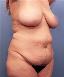 Tummy Tuck Before Photo by Marvin Shienbaum, MD; Brandon, FL - Case 30486