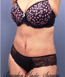 Tummy Tuck After Photo by Marvin Shienbaum, MD; Brandon, FL - Case 30486