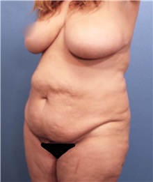 Tummy Tuck Before Photo by Marvin Shienbaum, MD; Brandon, FL - Case 30486