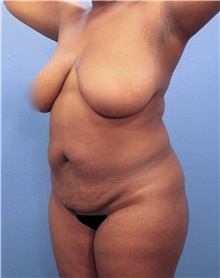 Tummy Tuck Before Photo by Marvin Shienbaum, MD; Brandon, FL - Case 30487