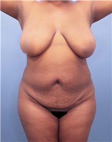 Tummy Tuck Before Photo by Marvin Shienbaum, MD; Brandon, FL - Case 30487