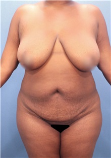 Tummy Tuck Before Photo by Marvin Shienbaum, MD; Brandon, FL - Case 30487