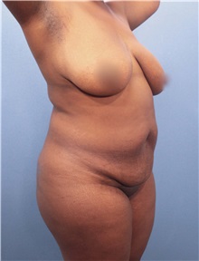 Tummy Tuck Before Photo by Marvin Shienbaum, MD; Brandon, FL - Case 30487