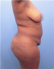 Tummy Tuck Before Photo by Marvin Shienbaum, MD; Brandon, FL - Case 30487