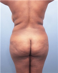 Tummy Tuck Before Photo by Marvin Shienbaum, MD; Brandon, FL - Case 30487