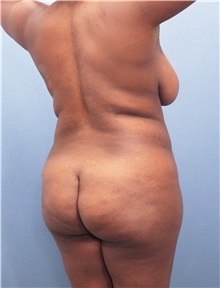 Tummy Tuck Before Photo by Marvin Shienbaum, MD; Brandon, FL - Case 30487