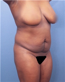 Tummy Tuck Before Photo by Marvin Shienbaum, MD; Brandon, FL - Case 30488