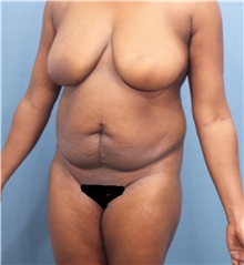 Tummy Tuck Before Photo by Marvin Shienbaum, MD; Brandon, FL - Case 30488