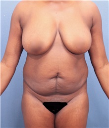 Tummy Tuck Before Photo by Marvin Shienbaum, MD; Brandon, FL - Case 30488