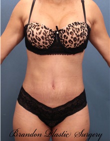 Tummy Tuck After Photo by Marvin Shienbaum, MD; Brandon, FL - Case 30489