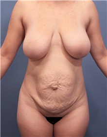 Tummy Tuck Before Photo by Marvin Shienbaum, MD; Brandon, FL - Case 30489