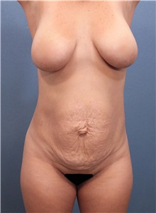 Tummy Tuck Before Photo by Marvin Shienbaum, MD; Brandon, FL - Case 30489