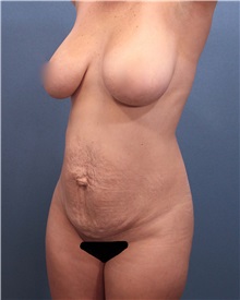 Tummy Tuck Before Photo by Marvin Shienbaum, MD; Brandon, FL - Case 30489