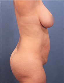 Tummy Tuck Before Photo by Marvin Shienbaum, MD; Brandon, FL - Case 30489