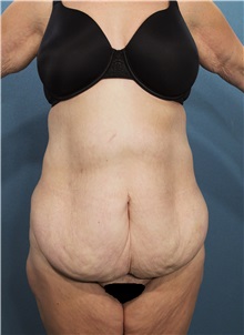 Tummy Tuck Before Photo by Marvin Shienbaum, MD; Brandon, FL - Case 30490