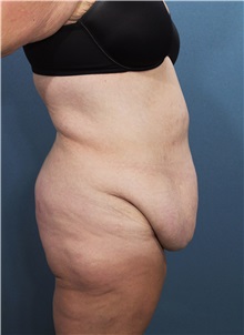 Tummy Tuck Before Photo by Marvin Shienbaum, MD; Brandon, FL - Case 30490