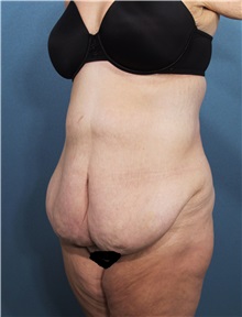 Tummy Tuck Before Photo by Marvin Shienbaum, MD; Brandon, FL - Case 30490