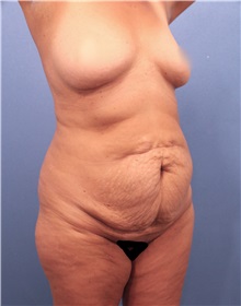 Tummy Tuck Before Photo by Marvin Shienbaum, MD; Brandon, FL - Case 30493