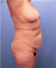 Tummy Tuck Before Photo by Marvin Shienbaum, MD; Brandon, FL - Case 30493