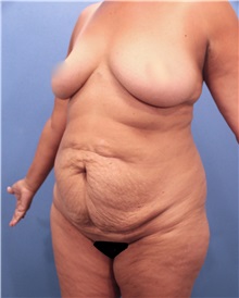 Tummy Tuck Before Photo by Marvin Shienbaum, MD; Brandon, FL - Case 30493