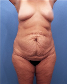 Tummy Tuck Before Photo by Marvin Shienbaum, MD; Brandon, FL - Case 30493