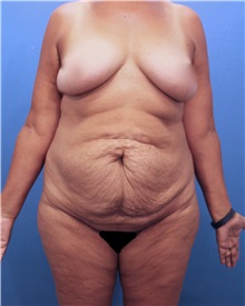 Tummy Tuck Before Photo by Marvin Shienbaum, MD; Brandon, FL - Case 30493