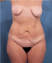 Tummy Tuck Before Photo by Marvin Shienbaum, MD; Brandon, FL - Case 30494